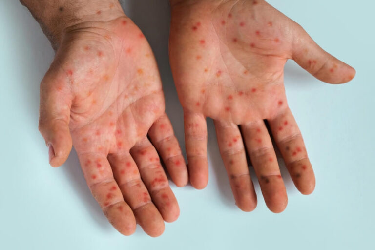 25 measles brain complications